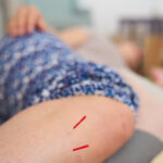 Akupunktur einer Schwangeren zur Geburtsvorbereitung